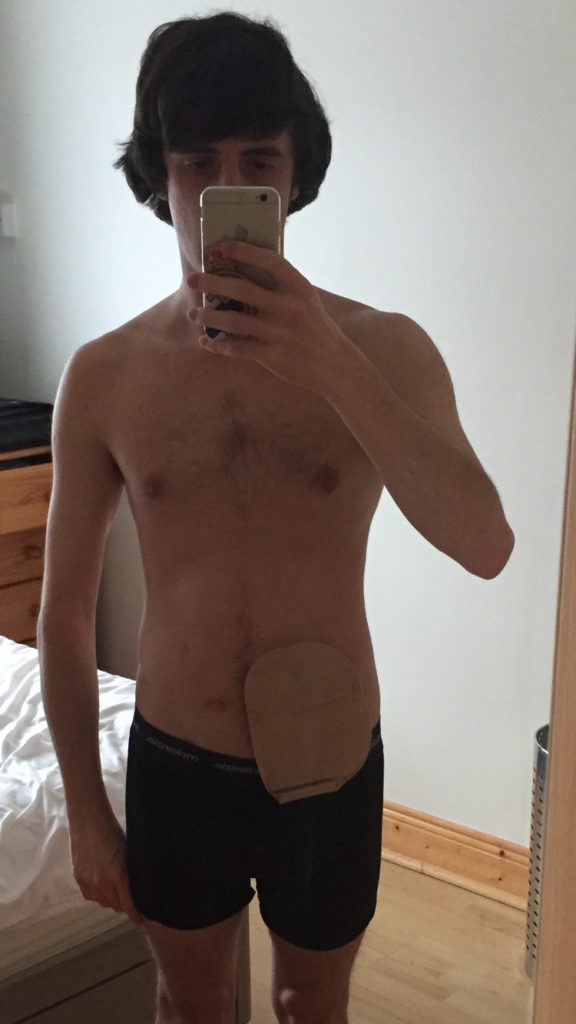 Andrew's stoma selfie, breaking the stigma and shame about stoma bags
